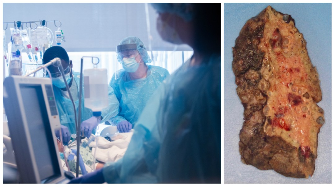 Disturbing Photo Shows What Coronavirus Can Do To Your Lungs